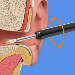 EarCare™ | Belaidis išmanusis ausų valymo otoskopas