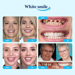 WhiteSmile™ – Dantų laminatė šypsenai atkurti